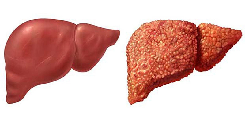 Xơ gan hay còn gọi là xơ cứng gan