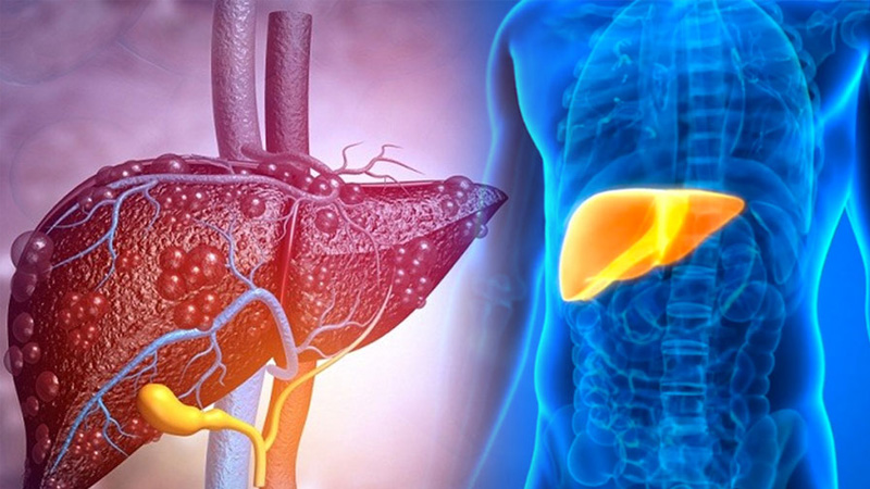 Âm gan tăng có thể gây ra một số vấn đề sức khỏe nghiêm trọng