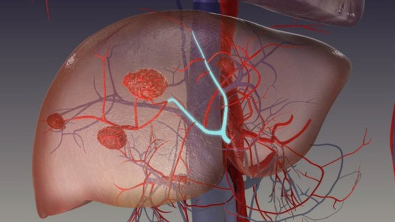 Âm gan tăng là gì? Âm gan tăng là sự thay đổi bất thường cấu trúc của gan