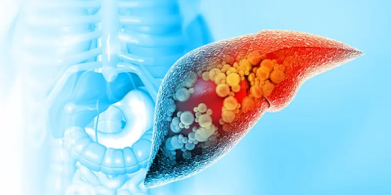 Bênh chai gan được xem là một bệnh lý gan nghiêm trọng