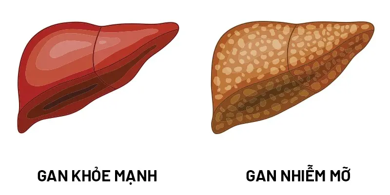 Lượng mỡ thừa tại gan ở gan nhiễm mỡ cấp độ 3 có thể lên tới hơn 66% trọng lượng gan