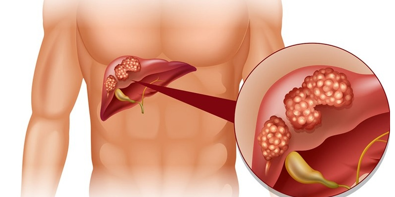 Hầu hết các trường hợp nang gan đều lành tính