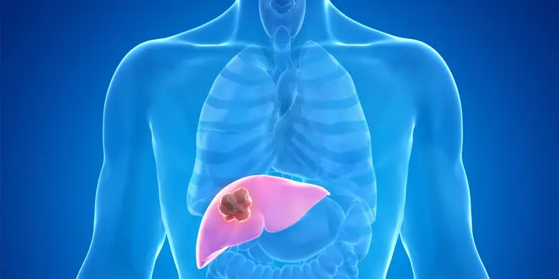 Ung thư gan là trạng thái mất kiểm soát trong quá trình phân chia và phát triển của các tế bào gan