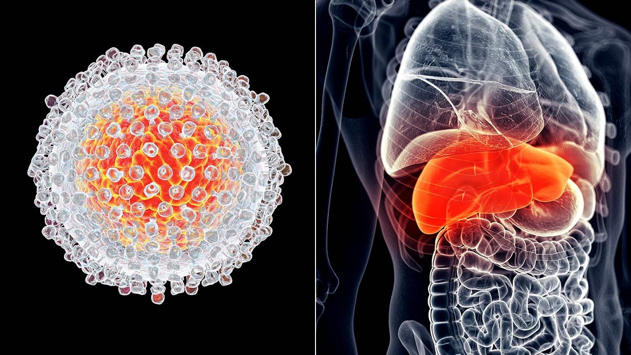 Bệnh viêm gan virus D