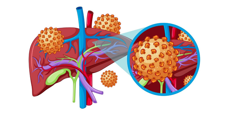 Bệnh viêm gan E khác gì viêm gan B là thắc mắc của nhiều người