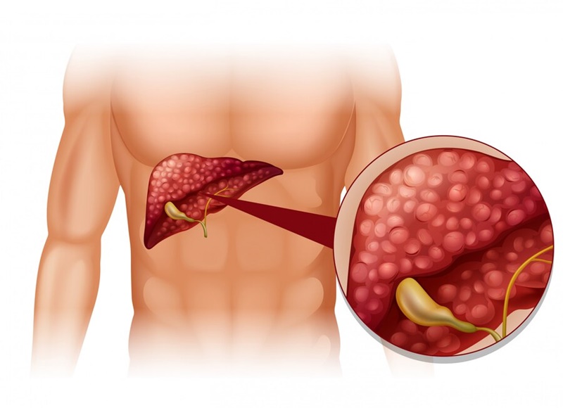 Bệnh viên mạn tính 