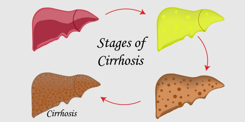 Bệnh xơ gan có thể hạn chế nếu phát hiện sớm và điều trị tích cực