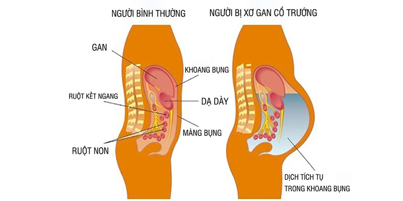 Xơ gan cổ trướng là bệnh vô cùng nguy hiểm