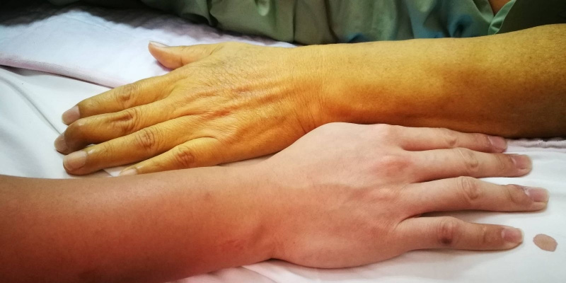 Vàng da là triệu chứng phổ biến của bệnh xơ gan