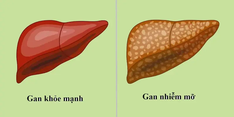 Bị bệnh gan nhiễm mỡ độ 3 sống được bao lâu?