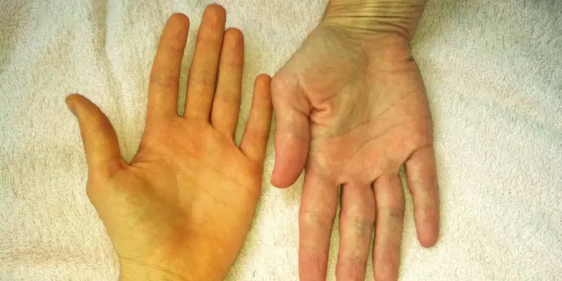 Vàng da là một biểu hiện không đặc hiệu của giãn đường mật trong gan