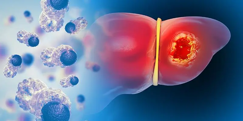 Ung thư gan là biến chứng nghiêm trọng của gan nhiễm mỡ độ trung bình