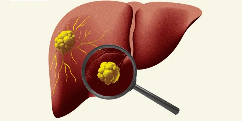 Khối u gan ác tính nguyên phát có xu hướng khu trú tại một phân thùy của gan cụ thể