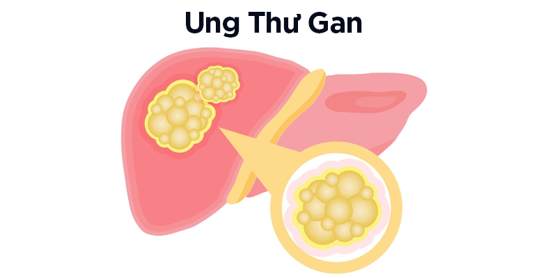 Ung thư gan là sự tăng trưởng và phát triển không kiểm soát của các tế bào ung thư tại gan