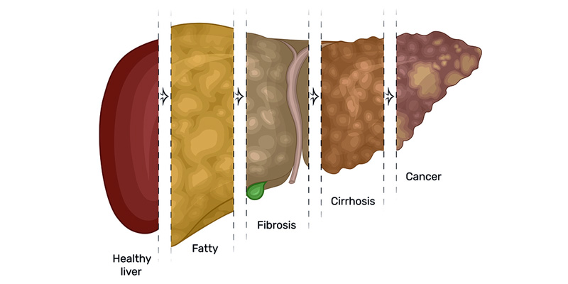 Các giai đoạn tổn thương gan tiến triển, gây các biến chứng khác nhau cho bệnh