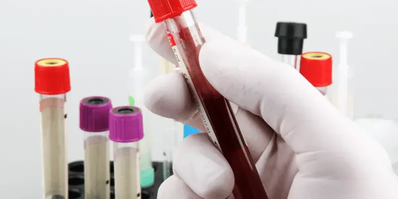 Chẩn đoán viêm gan C cấp tính thông qua các xét nghiệm huyết thanh học