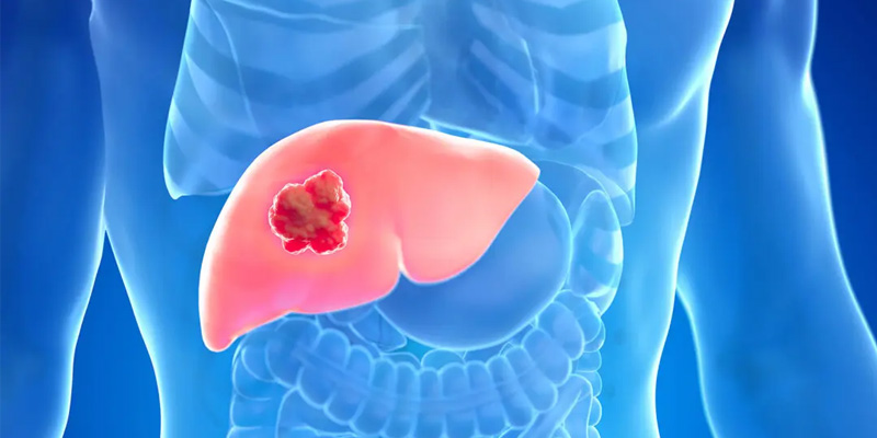 Ung thư gan được xếp vào nhóm bệnh lý ác tính nguy hiểm nhất, có tỷ lệ tử vong cao