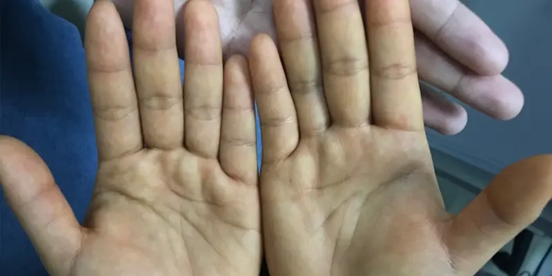 Cảnh giác các triệu chứng vàng da, vàng mắt