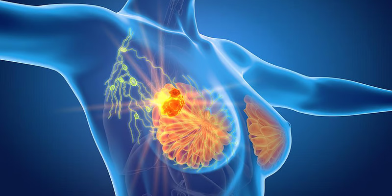 Câu hỏi ung thư vú di căn gan sống được bao lâu