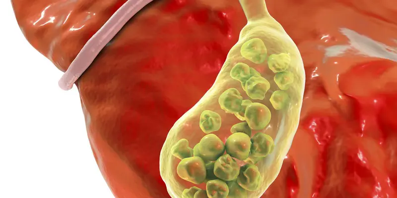 Sỏi đường mật chính là một trong những nguyên nhân gây giãn đường mật trong gan