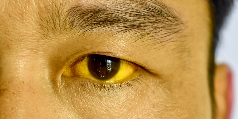 Chẩn đoán viêm gan C cấp tính gây ra các triệu chứng như da vàng khác