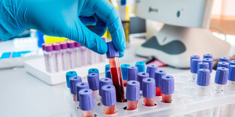 Kết quả xét nghiệm là chẩn đoán chính xác viêm gan E