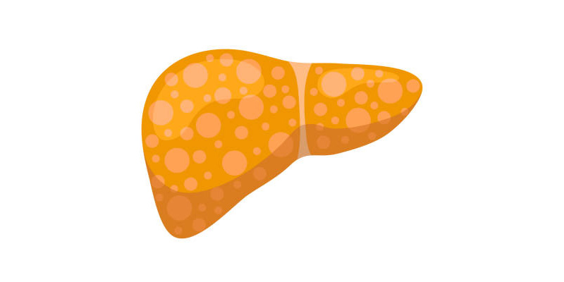 Gan nhiễm mỡ độ 2 có thể được kiểm soát nhờ chế độ ăn khoa học.