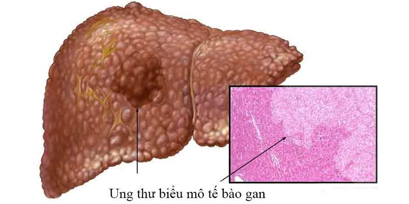 Chỉ định của thuốc Stivarga 40mg cho người ung thư biểu mô tế bào gan