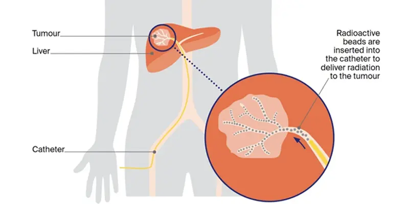 Chi phí nút mạch ung thư gan bao gồm nhiều khoản khác nhau