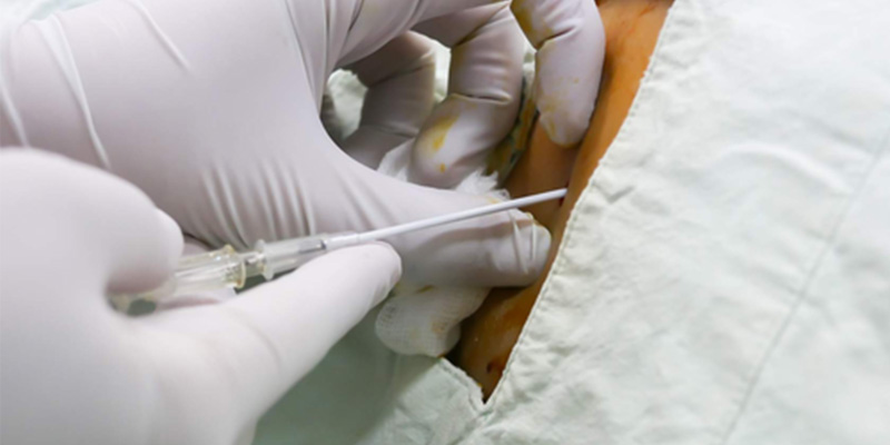 Thủ thuật chọc dịch màng bụng là thủ thuật có xâm lấn vào thành bụng, nhằm hút dịch giữa màng bụng và các cơ quan.