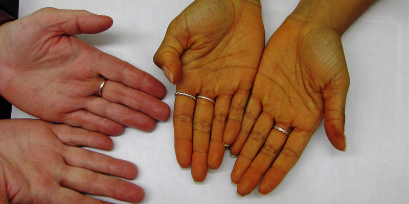 Vàng da là dấu hiệu cho biết đang mắc bệnh xơ gan cổ trướng giai đoạn cuối