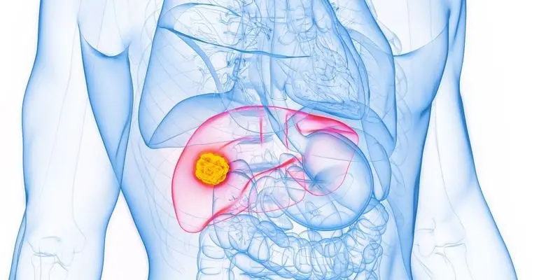 Nút mạch ung thư gan là một trong những phương pháp điều trị hiệu quả