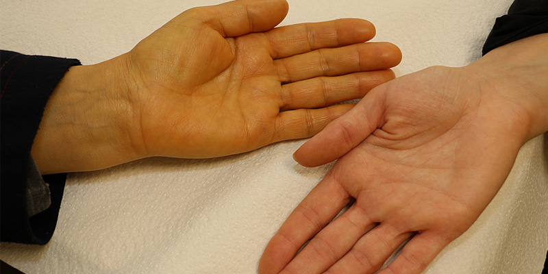 Vàng da là dấu hiệu gan nhiễm mỡ bạn cần phải lưu ý