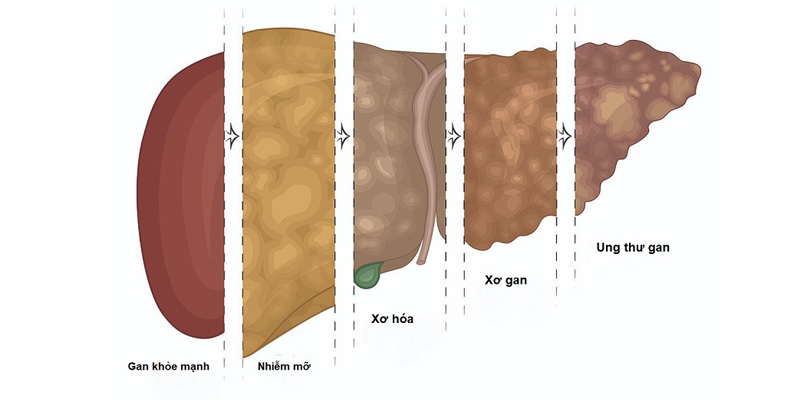 Các giai đoạn gan nhiễm mỡ và những dấu hiệu cần lưu ý