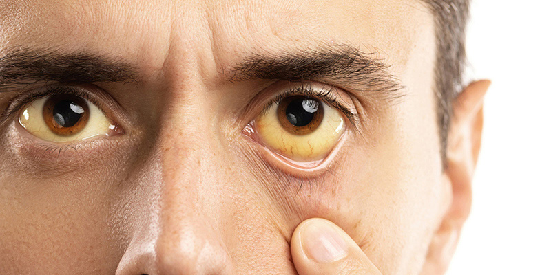 Vàng da, vàng mắt là triệu chứng đặc trưng của nhiều bệnh lý về gan, trong đó có bệnh khô gan