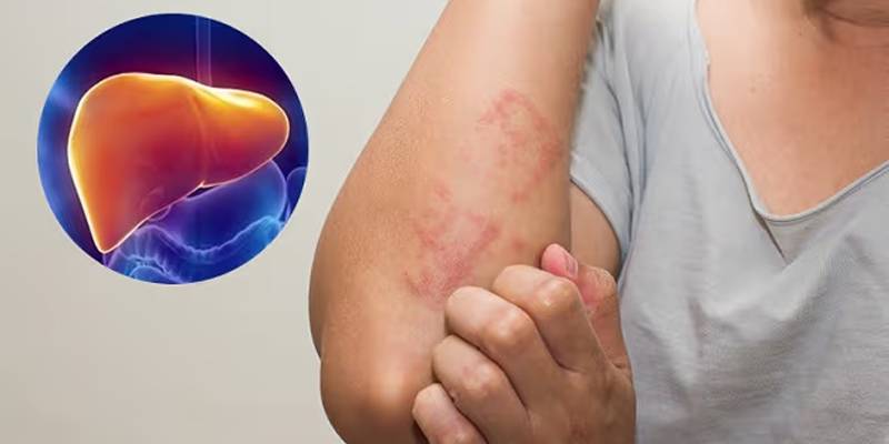 Người có vấn đề về gan thường có những cơn ngứa râm ran