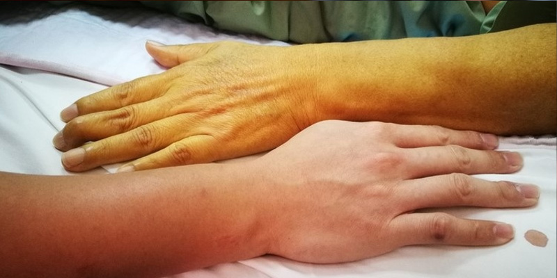 Vàng da là một trong những biểu hiện cho thấy gan bị nhiễm độc