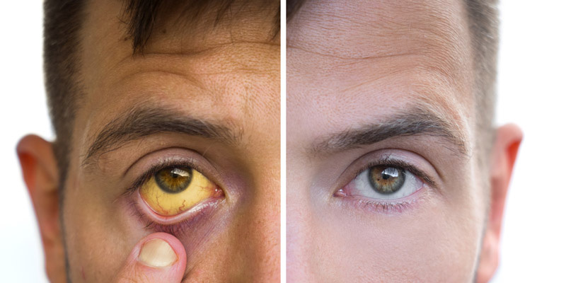 Vàng mắt là dấu hiệu cho thấy chức năng gan của bạn đang bị suy giảm