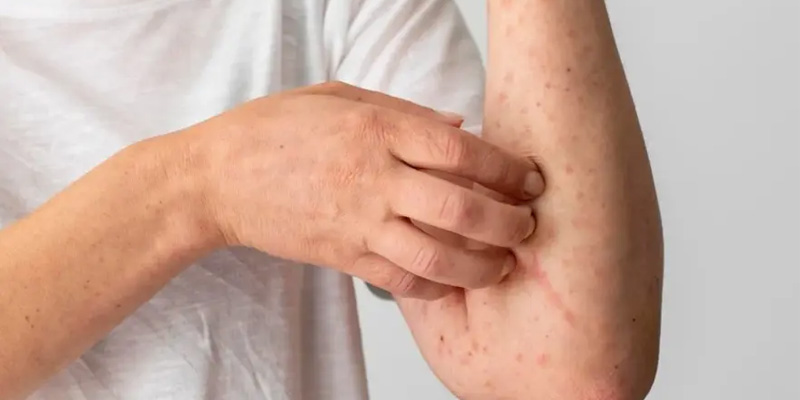 Da xuất hiện nhiều mụn khả năng gan đang gặp vấn đề