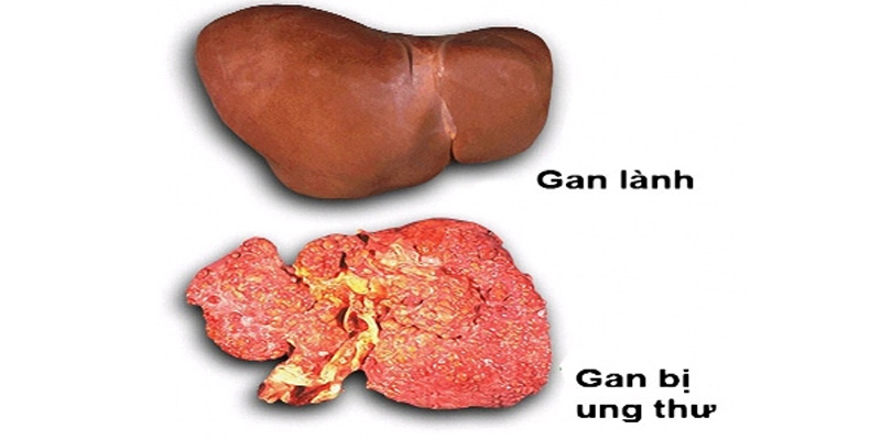 Chẩn đoán bệnh ung thư gan nguyên phát