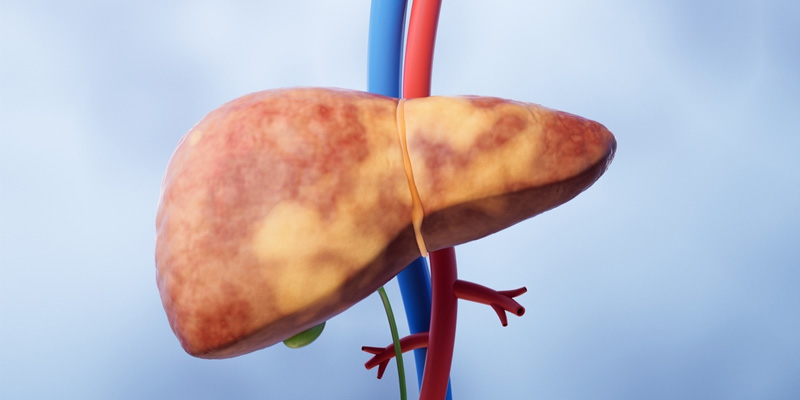 Điều trị gan nhiễm mỡ