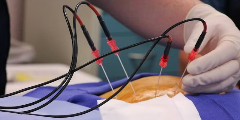 Đốt u cao tần là phương pháp điều trị phổ biến với những trường hợp có khối u nhỏ.