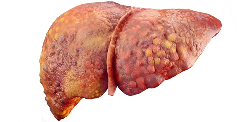 Gan nhiễm mỡ sẽ làm hạn chế khả năng gan thải độc