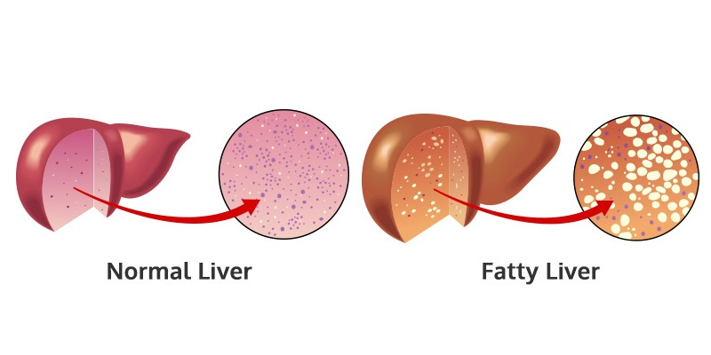 Hình ảnh so sánh giữa gan thường và gan nhiễm mỡ