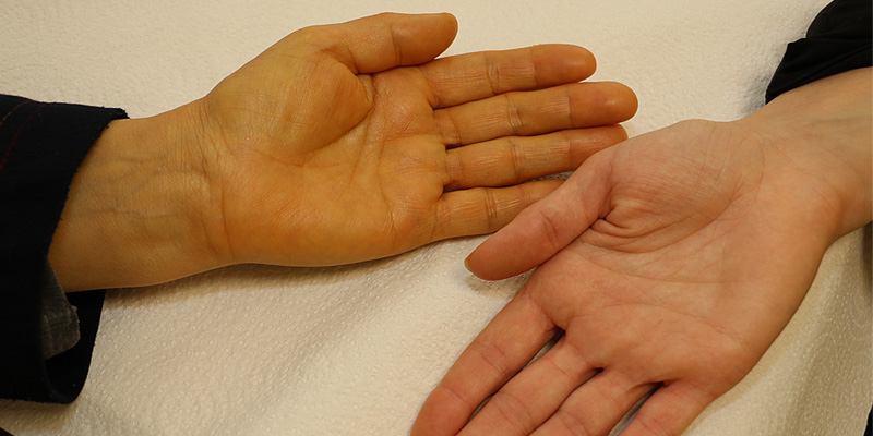 Vàng da là triệu chứng phổ biến của bệnh