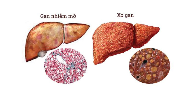 Gan nhiễm mỡ độ 1 có thể trở nặng thành các bệnh nguy hiểm như xơ gan