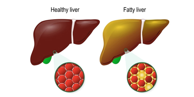 Gan nhiễm mỡ là tình trạng tích tụ mỡ trong gan