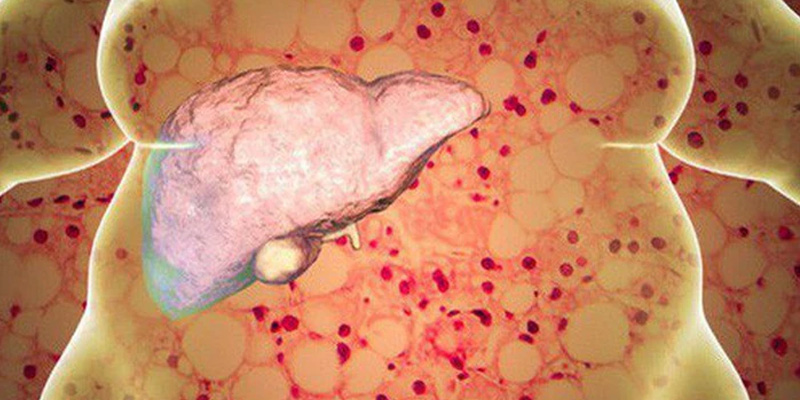 Gan nhiễm mỡ độ 2 là tình trạng nghiêm trọng