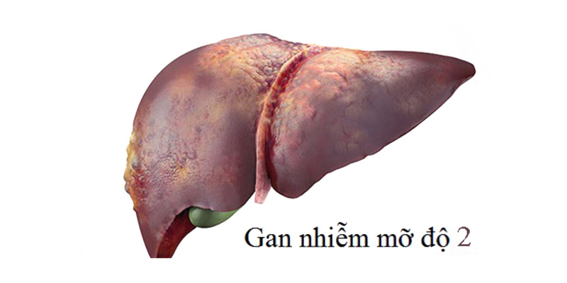 Gan nhiễm mỡ độ 2 kiêng gì? Gan nhiễm mỡ độ 2 kiêng các thực phẩm dầu mỡ, nhiều chất béo, đặc biệt là rượu bia