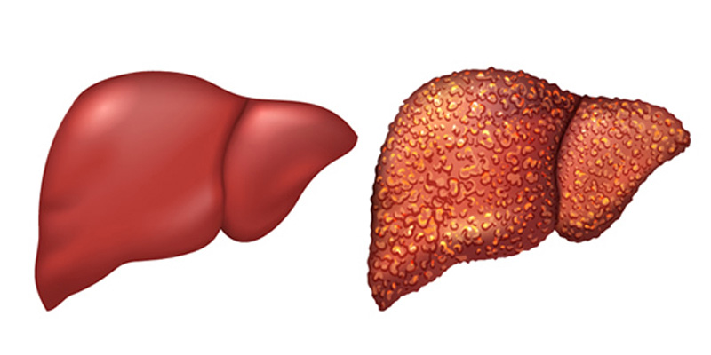 Gan nhiễm mỡ độ 3 là giai đoạn nghiêm trọng nhất của bệnh gan nhiễm mỡ